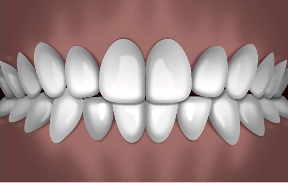 Digital smile design showing idealized white teeth alignment and occlusion for orthodontic treatment planning.