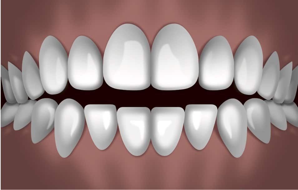 Perfectly aligned white teeth displayed in frontal view against brown background showing ideal orthodontic results.