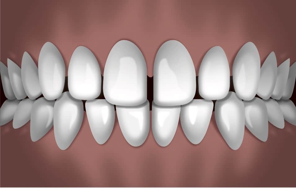 Digital rendering of perfectly aligned white teeth in frontal view, showing ideal orthodontic smile results.