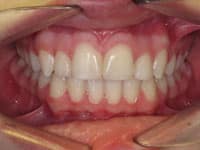 Close-up of teeth showing dental alignment and gum health in clinical orthodontic setting.