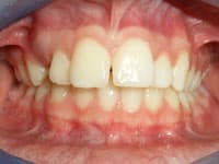 Close-up of upper and lower teeth showing dental alignment and bite relationship in orthodontic examination.