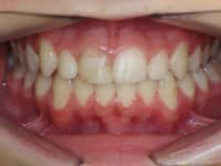 Close-up of patient's teeth showing dental alignment and bite correction during orthodontic treatment.