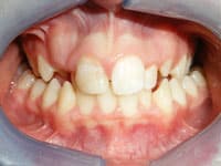 Close-up of open mouth showing misaligned teeth before orthodontic treatment.
