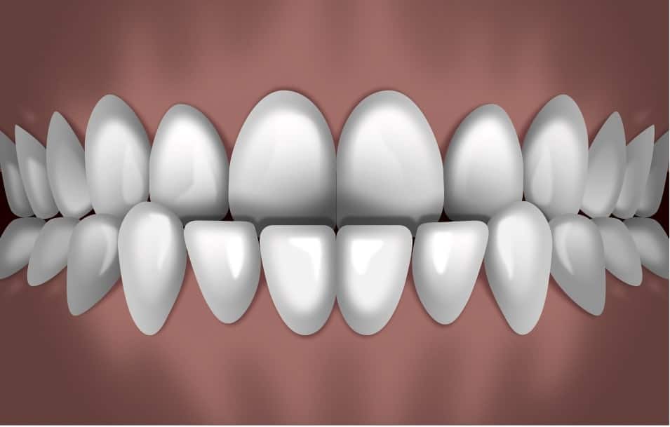 Digital rendering of aligned white teeth in ideal bite position for orthodontic treatment demonstration.