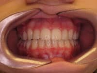Close-up view of teeth and gums showing dental alignment during orthodontic examination or treatment.