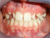 Close-up of teeth showing malocclusion with misaligned upper and lower teeth before orthodontic treatment.