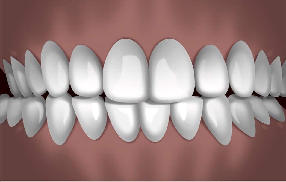 Perfect white teeth alignment shown in frontal view demonstrating orthodontic treatment results.