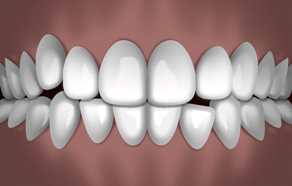 Digitally rendered smile showing perfectly aligned white teeth in frontal view against neutral background.
