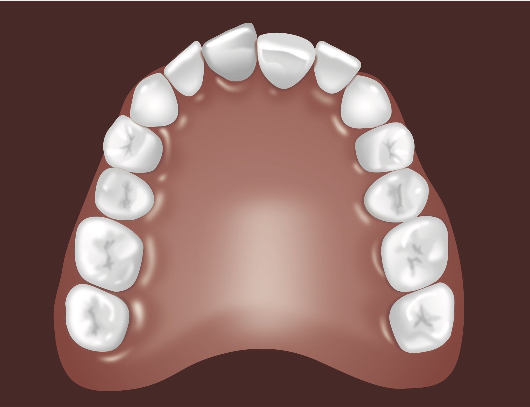 Dental arch model showing upper teeth arrangement for orthodontic treatment planning and patient education.