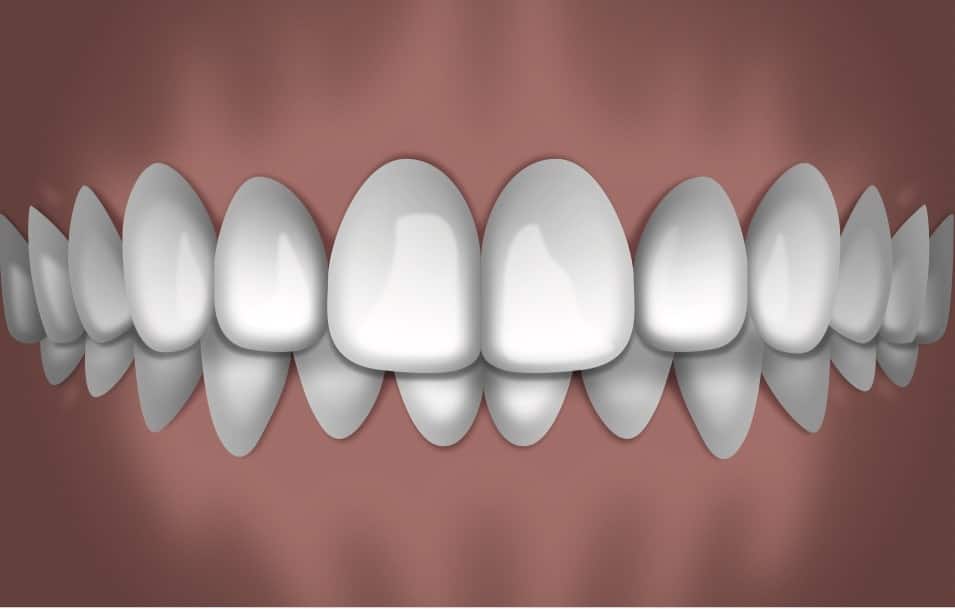 Digital rendering of perfectly aligned white teeth displayed against pink gum background for orthodontic reference.