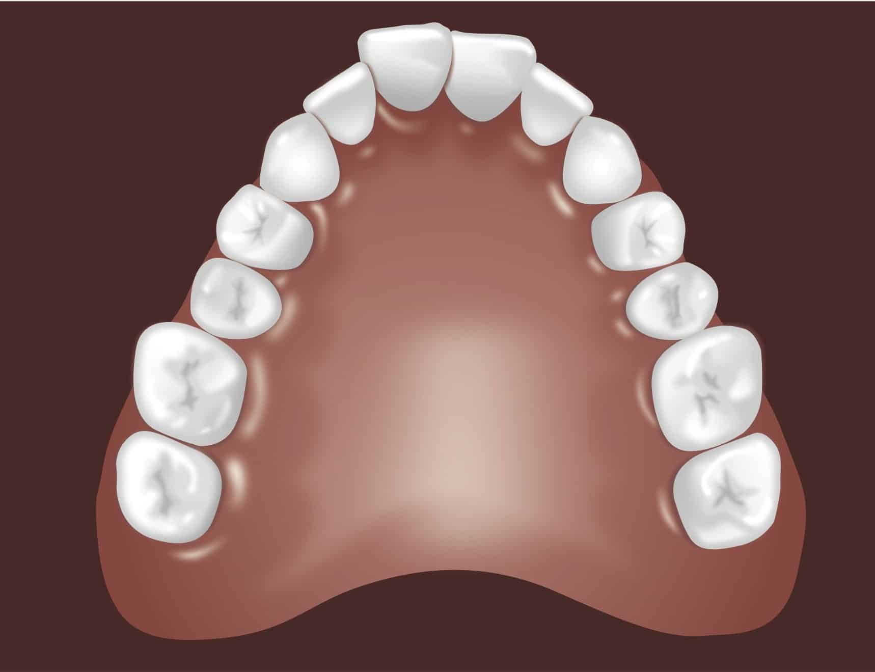 Dental arch model showing upper teeth arrangement on brown background for orthodontic reference.