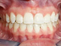 Straight white teeth displayed in close-up dental photograph showing healthy smile alignment.