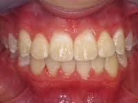 Close-up dental view showing upper and lower teeth with slight spacing and discoloration before orthodontic treatment.