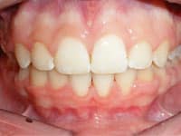 Close-up view of upper front teeth showing white, evenly aligned teeth and healthy pink gums.