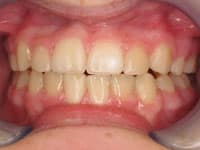 Close-up of teeth showing dental alignment and bite relationship in orthodontic examination.