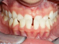 Close-up dental photograph showing upper teeth with spacing gaps and gum tissue in clinical setting.