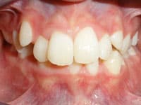 Close-up of patient's teeth showing orthodontic results with aligned upper front teeth and visible gum tissue.