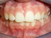 Close-up intraoral view of upper front teeth showing dental alignment and bite assessment.