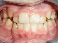 Close-up of misaligned teeth showing crowding and spacing issues before orthodontic treatment.