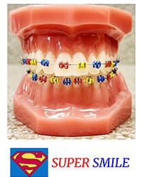 Colorful orthodontic braces displayed on dental model with "Super Smile" Superman logo text below.