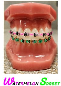 Dental model displaying colorful orthodontic braces on teeth with watermelon sorbet label.