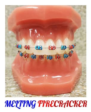 Dental model displaying colorful braces with "Melting Firecracker" design theme for orthodontics.