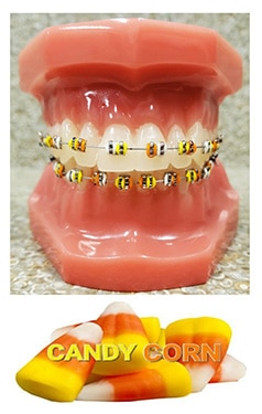 Dental model displaying gold braces with candy corn, illustrating orthodontic treatment options.