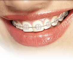Close-up of smile showing teeth with ceramic braces and brackets on upper teeth.