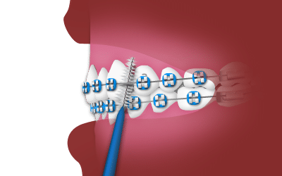 Dental braces on teeth with toothbrush, orthodontic treatment illustration.