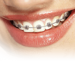 Close-up of smile showing metal braces on upper teeth with elastic bands.