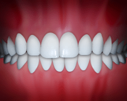 Straight white teeth aligned in perfect bite against pink gum background, orthodontic treatment result.