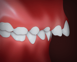 Misaligned teeth shown in profile against red background, demonstrating dental crowding requiring orthodontic treatment.