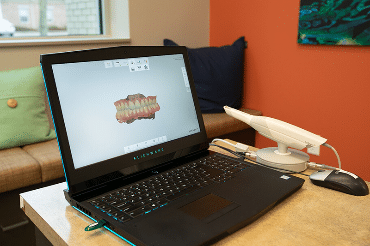 Dental 3D scanner displaying detailed tooth model on laptop screen during digital dental imaging.