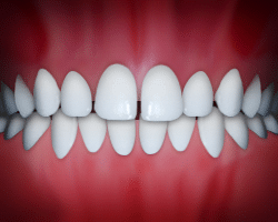Perfect white teeth aligned in orthodontic smile against red gum background.