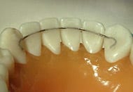 Close-up of upper teeth with clear aligners or braces showing orthodontic treatment progress.