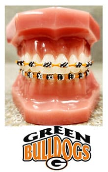 Open mouth model displaying metal braces with Green Bulldogs logo orthodontics branding.