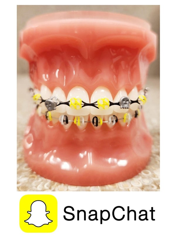 Dental model displaying yellow and metal braces on upper teeth with pink gums
