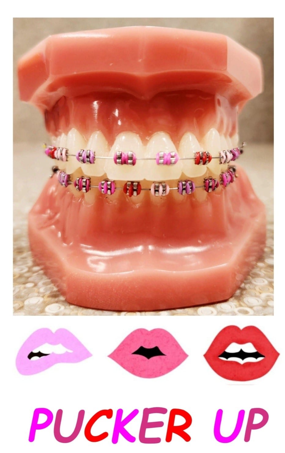 Braces